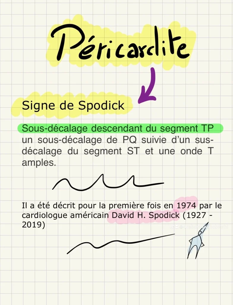 Signe de Spodick, fiche ecg
