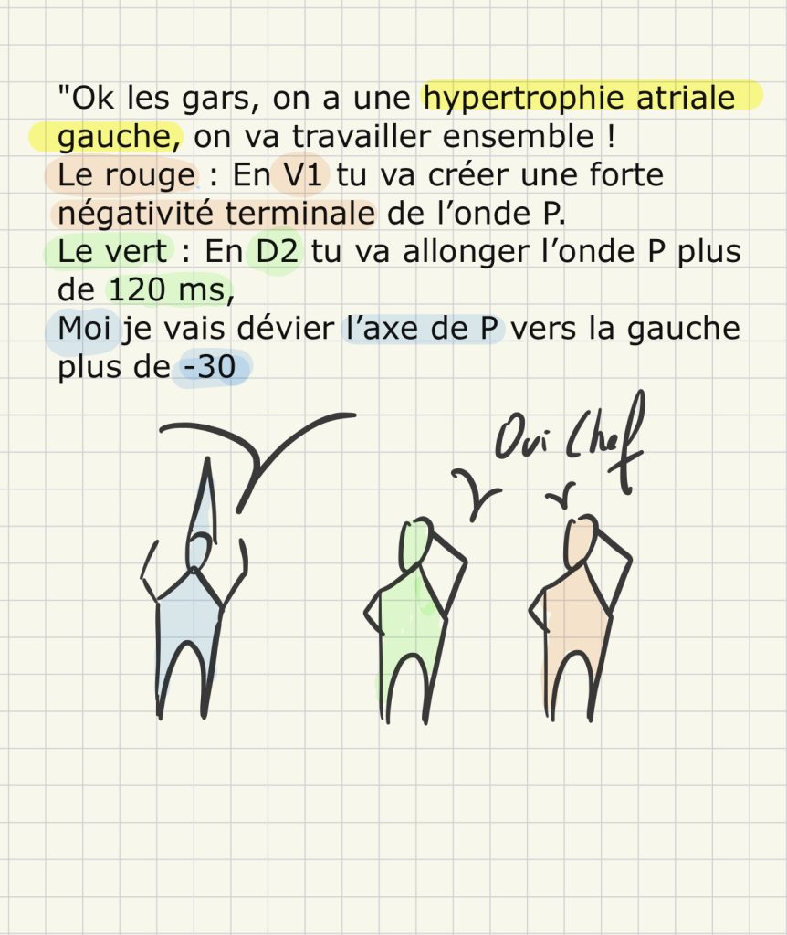 L'hypertrophie atriale gauche sur l'ecg