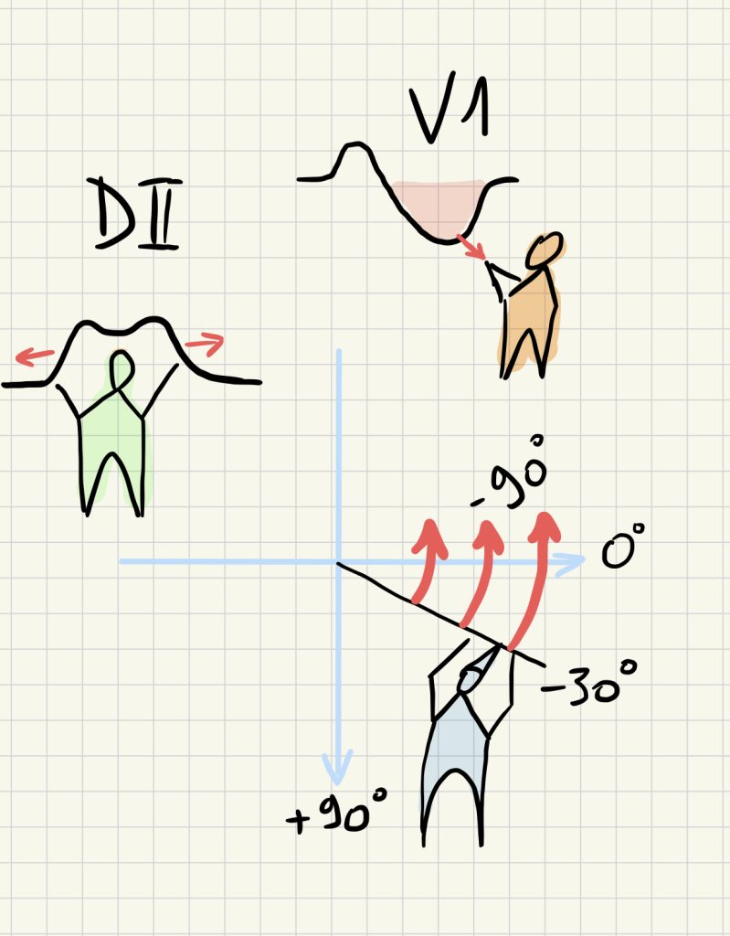 Représentation graphique (moyen mnémotechnique) pour se mémoriser l'hypertrophie atriale gauche sur l'ECG