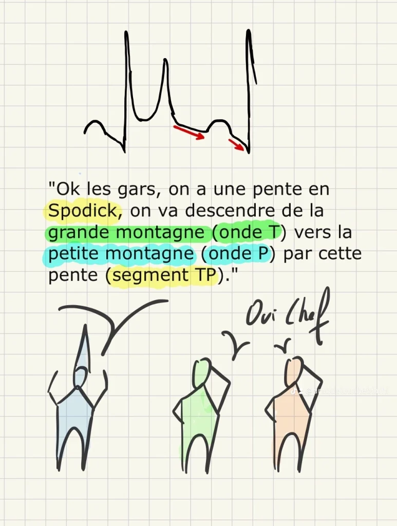 Signe de Spodick : représentation graphique. 