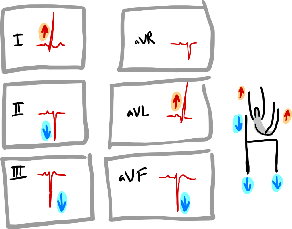 Bloc fasciculaire antérieur gauche -moyen mnémotechnique
