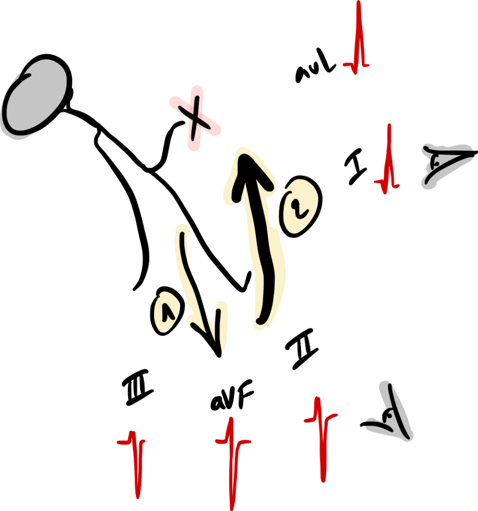 bloc fasciculaire antérieure gauche, les vecteurs