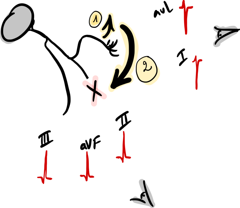bloc fasciculaire posterieur gauche, les vecteurs