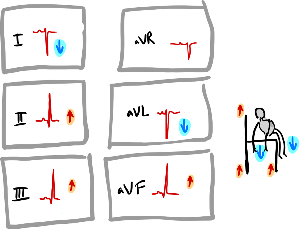 Moyen mnémotechnique pour le bloc fasciculaire postérieur gauche.