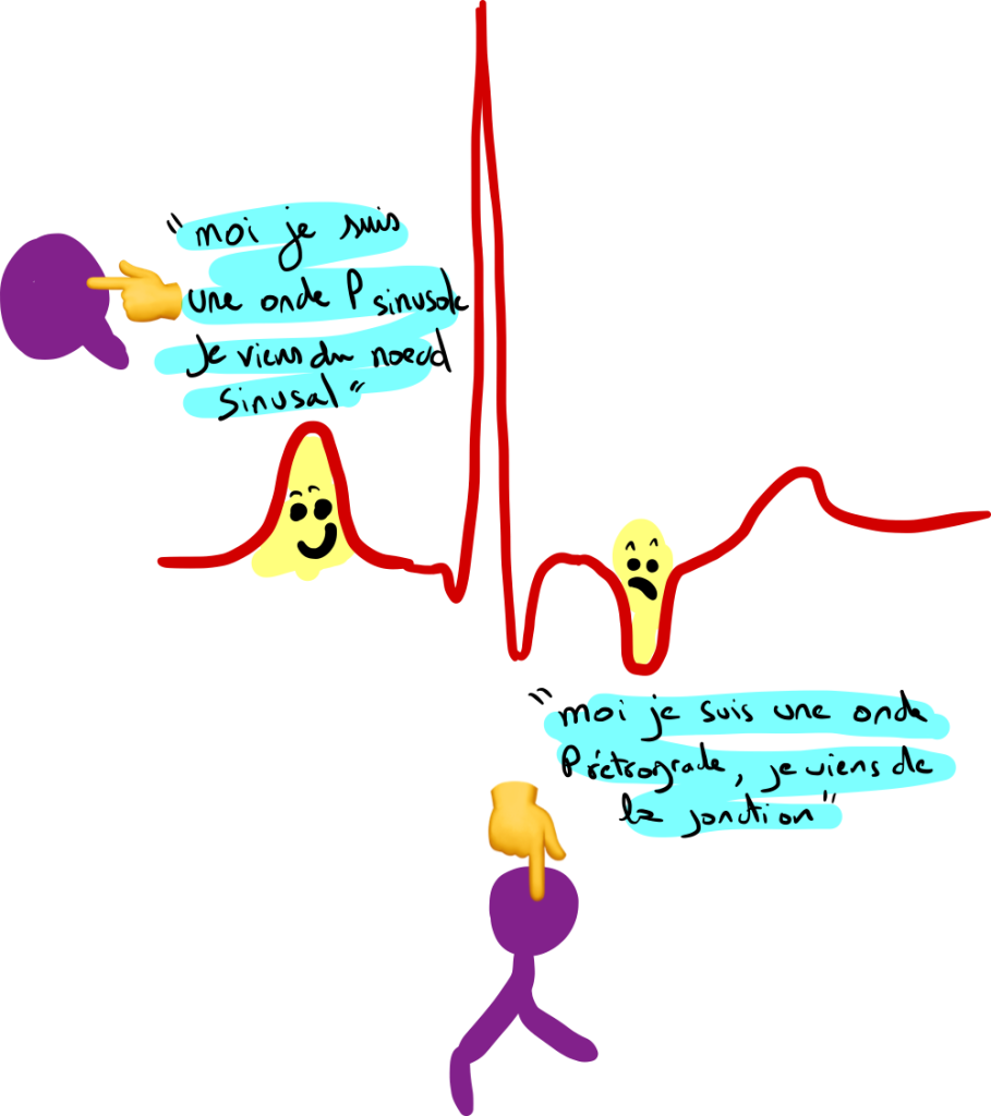 Onde P sinusale VS onde P rétrograde.
