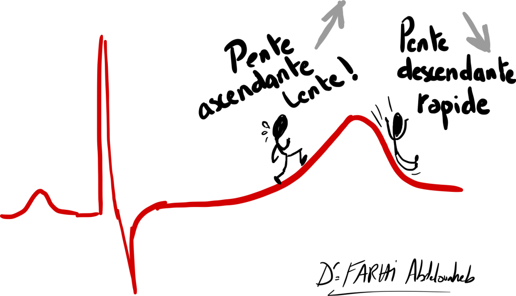 L'onde T sur l'ECG : représentation de la pente ascendante et descendante.